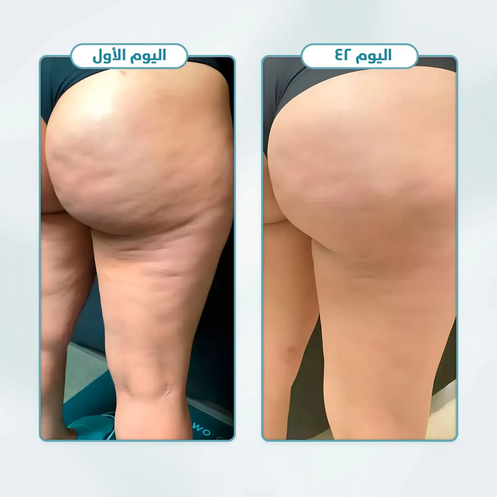 Vaovac™ Anti-Cellulite Massager